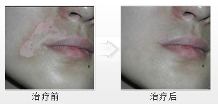 治愈白癜風,尋找美麗夢想 治愈白癜風,尋找美麗夢想