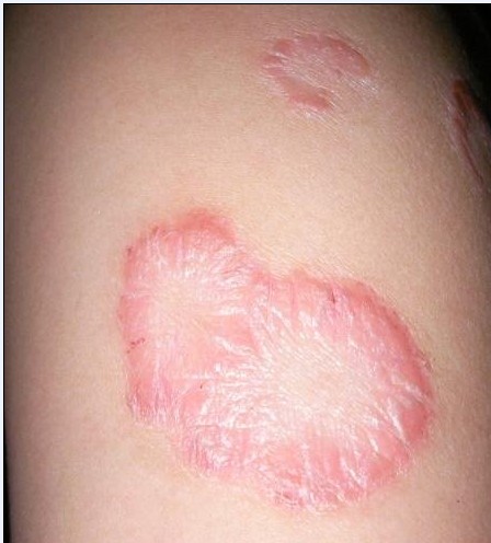 患了牛皮癬應該怎么治療