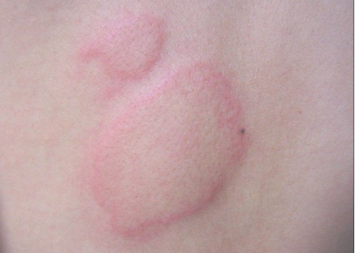 引起蕁麻疹的原因有哪些 引起蕁麻疹的原因有哪些