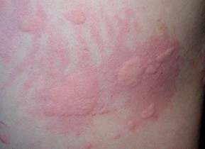 避免蕁麻疹的注意事項有哪些 避免蕁麻疹的注意事項有哪些