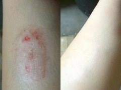 治療牛皮癬開啟新生活