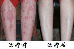 牛皮癬治療