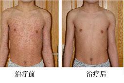 牛皮癬治療