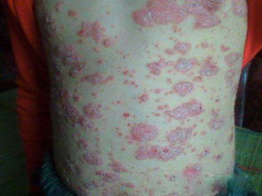 牛皮癬多年來(lái)一直反復(fù)怎么辦