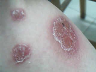 得了點滴狀牛皮癬用什么方法好