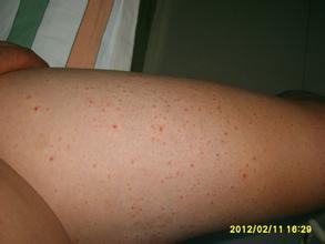 牛皮癬患者生活需要多小心嗎