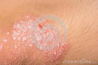 牛皮癬的激素治療需要特別注意