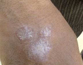 關節型牛皮癬手腕腫了一個大包怎么辦