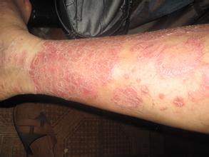 如何做才能夠加快牛皮癬的治療