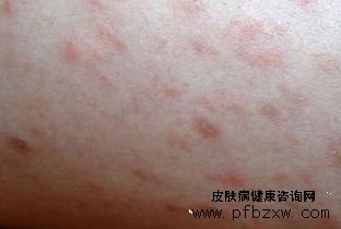 牛皮癬和過敏如何準(zhǔn)確區(qū)分