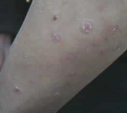 頭上身上長了牛皮癬如何是好