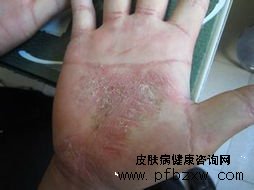 牛皮癬可以抓自己的皮膚嗎