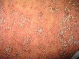 牛皮癬患者夏天洗澡需要特別注意什么