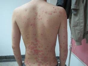 目前治療牛皮癬的藥物都有哪些種類