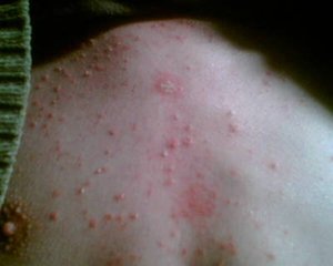 小蘇打加醋真的能治好牛皮癬嗎