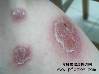 牛皮癬好了又復(fù)發(fā)怎么做