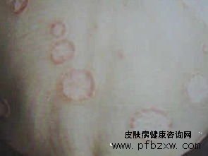 懷孕的牛皮癬患者孕期如何調理