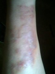 多年復(fù)發(fā)型牛皮癬護理注意事項