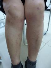 牛皮癬如何科學止癢要清楚