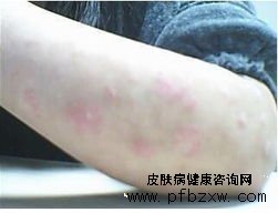 牛皮癬能完全治好的方法都有什么