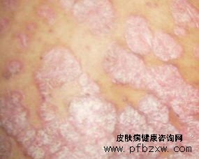 牛皮癬患者能吃一些醬菜嗎