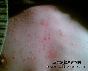 牛皮癬求治心切，雪上加霜