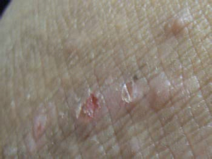 后天的牛皮癬會不會遺傳呢