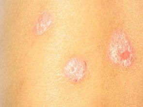 【找藥】哪種藥對牛皮癬病情恢復最大