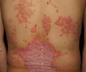 牛皮癬疾病需要手術(shù)治療嗎