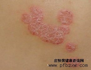 孕期可以治療牛皮癬嗎