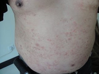 哪些治療牛皮癬的中成藥有效