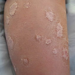 治療紅皮型牛皮癬最好的藥是什么