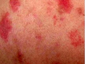 紅皮型牛皮癬會誘發(fā)哪些并發(fā)癥