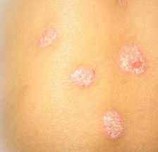 銀屑病的康復(fù)療法有哪些呢