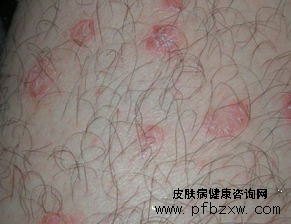 手部牛皮癬治療有什么特效藥嗎