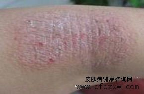 牛皮癬具體是怎么引起的