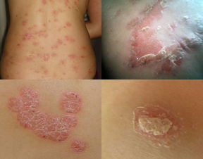 牛皮癬是皮膚病為啥會影響指甲健康