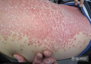 牛皮癬會影響患者的生育嗎