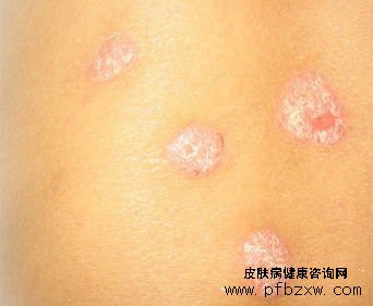 季節性的牛皮癬要如何更好的預防