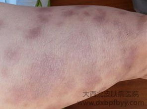 膿皰型牛皮癬可以治好嗎
