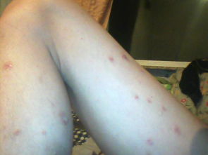 小孩牛皮癬的具體治療方法是什么