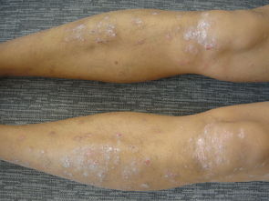 不同程度的牛皮癬治療方法不同