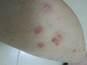 牛皮癬患者偶爾吸煙可以嗎