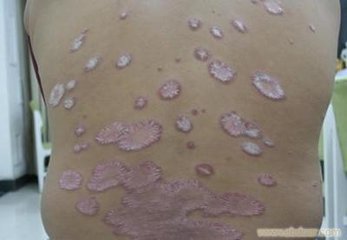 科學治療牛皮癬能避免遺傳嗎