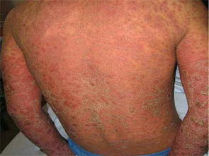 牛皮癬患者能使用偏方治療嗎