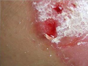 牛皮癬初期的治療費用一般是多少