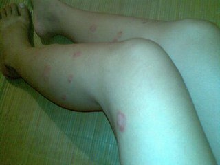 發(fā)病多久的牛皮癬最好治療呢