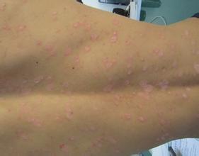 牛皮癬怎樣治療不復發