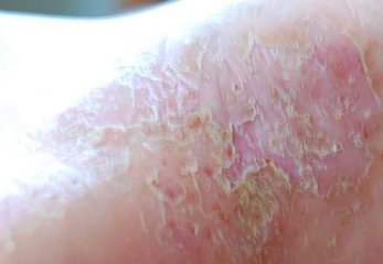 紅皮型牛皮癬還可以治療嗎