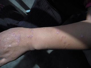 復發尋常性的牛皮癬怎么治療最有效